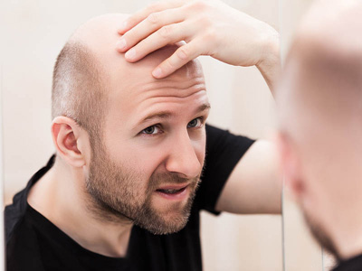 Cómo La Calvicie Afecta La Buena Autoestima De Los Hombres